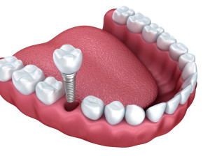Варианты протезирования зубов